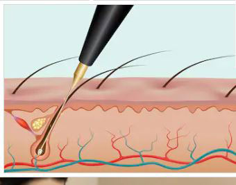 Best Hair Transplant in Hyderabad Skin Care Clinics in Hyderabad