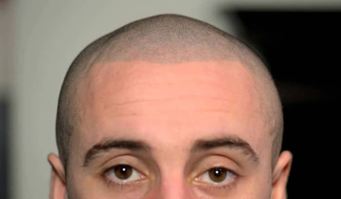 How Long Does Scalp Micropigmentation Last? – Chronic Ink