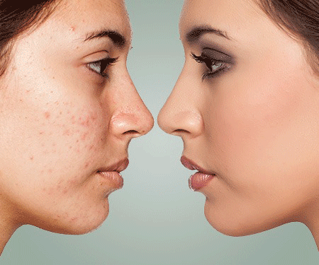 acne-scare treatment